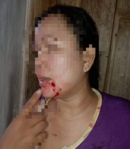 Korban Pengeroyokan Bernama Damai Pitri, Laporkan Hamidah Cs Ke Mapolres Bungo