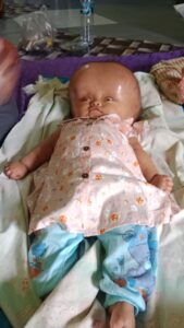 Butuh Uluran Tangan, Bayi 8 Bulan Penderita Hidrosefalus