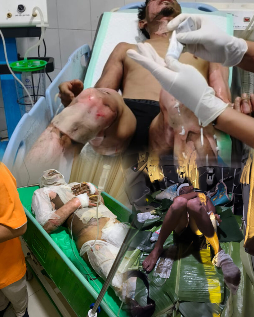Sumur Minyak Ilegal di Batanghari Kembali Makan Korban, 4 Pekerja Mengalami Luka Bakar